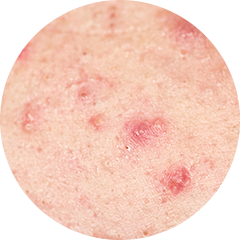 ニキビや炎症を起こした肌のクローズアップ写真