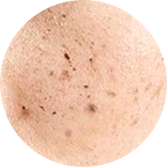 ピコトーニング治療後の肌のクローズアップ写真